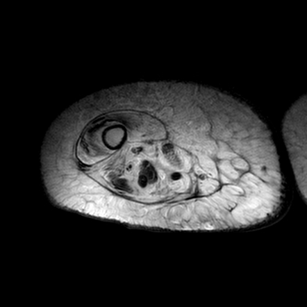 Representation of lymphatic swelling.